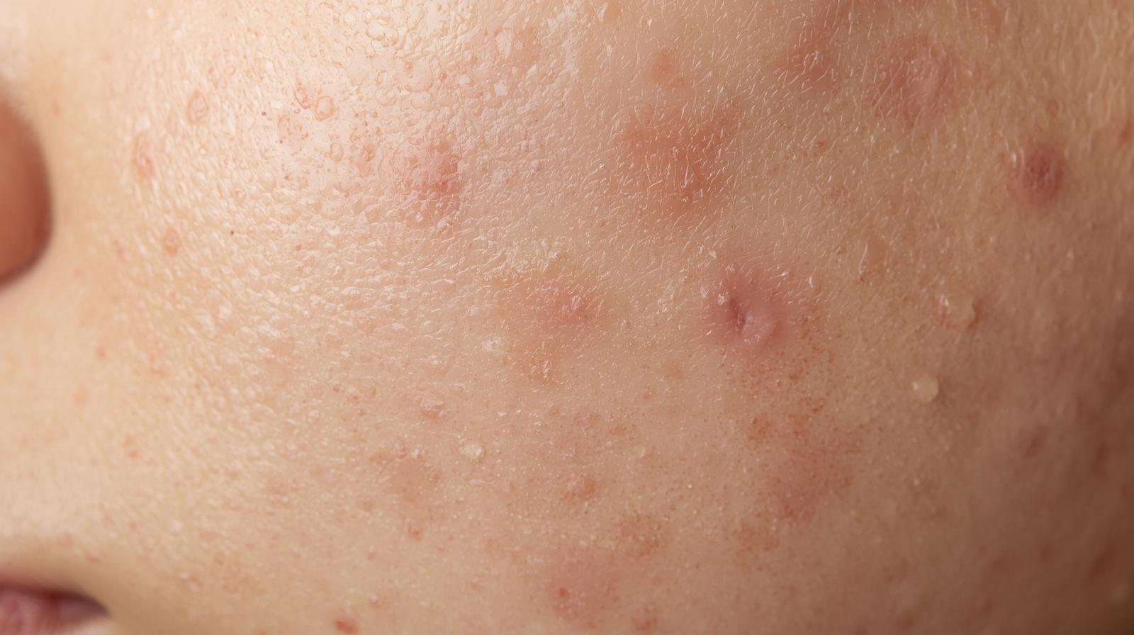 Can birth-control pills reduce your acne? And what happens when you stop taking them?